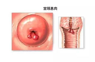 leep刀宮頸息肉手術(shù)后注意事項