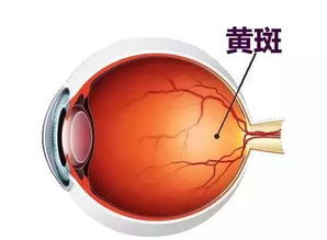 黃斑水腫有什么注意事項(xiàng)
