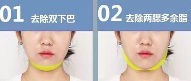 面部抽脂手術(shù)注意事項