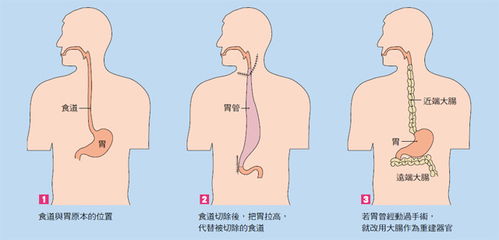 食道癌手術后的飲食注意事項,食道癌手術前注意事項,食道癌早期手術后飲食注意事項