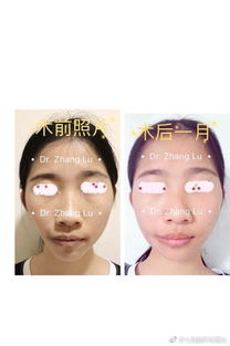 整形,面部,不對稱(chēng),注意事項