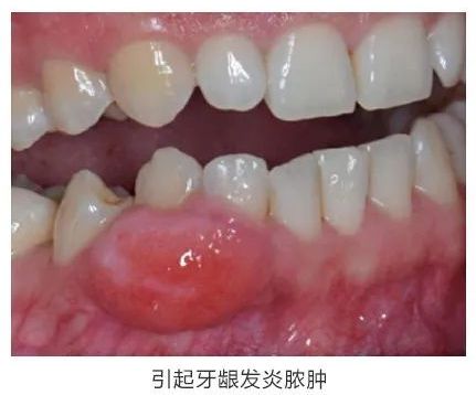 蛀牙后補牙注意事項