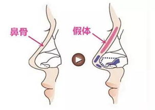 合肥假體隆鼻注意事項(xiàng)是什么