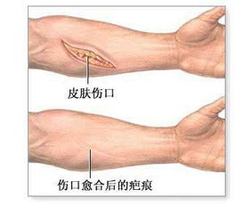 瘢痕注意事項(xiàng)