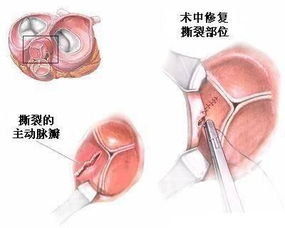 換生物瓣膜后注意事項