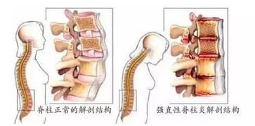 未分化脊柱關(guān)節炎注意事項,單發(fā)性關(guān)節炎注意事項,創(chuàng  )傷性關(guān)節炎的注意事項