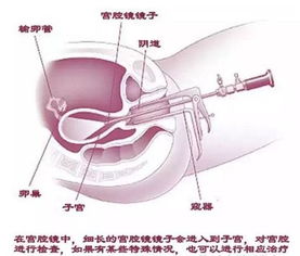 試管,注意事項(xiàng),宮腔鏡