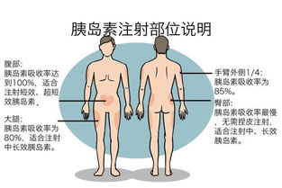 寫出胰島素注射的注意事項