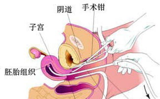 人流同時(shí)上環(huán)注意事項