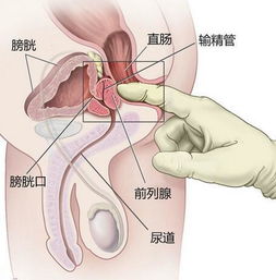 吃前列腺的藥注意事項