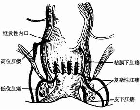 肛瘺內(nèi)瘺的護理及注意事項