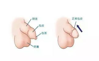 包皮長(cháng)自己天天注意事項才能不長(cháng)