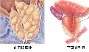 前列腺插管治療后注意事項(xiàng)
