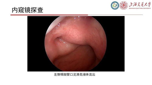腦脊液耳漏注意事項(xiàng),頭部外傷注意事項(xiàng),頭部ct注意事項(xiàng)