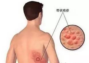 帶狀皰疹的注意事項,帶狀皰疹注意事項和飲食,帶狀皰疹疫苗接種注意事項