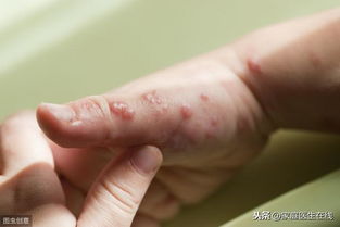 輕度帶狀皰疹注意事項