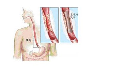 食道癌,手術后,注意事項