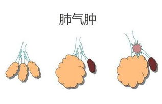 肺氣腫,青海,注意事項