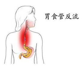 返流胃炎注意事項(xiàng)