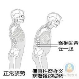 置換關節(jié)術后注意事項