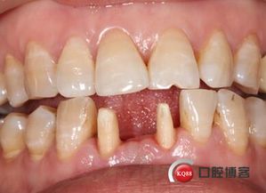 修復(fù),注意事項(xiàng),全瓷冠