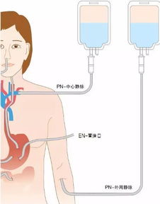腸外營養(yǎng)支持的注意事項