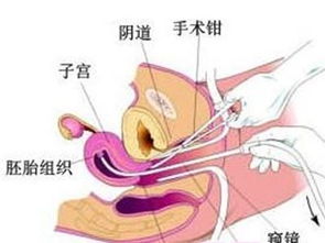 做完刮宮術后注意事項