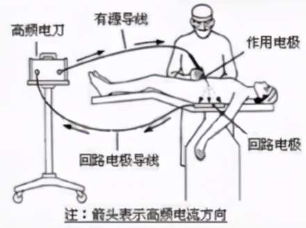 手術(shù)使用電刀注意事項