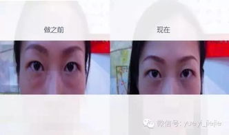 離子光波去眼袋后注意事項(xiàng)