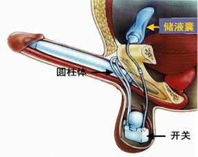 假體隆胸術后注意事項,假體下巴術后注意事項,假體下巴術后注意事項及護理