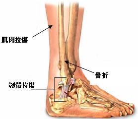腳踝,應(yīng)注意,骨折,事項(xiàng)