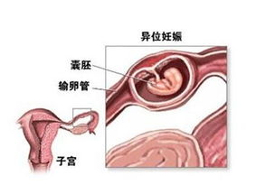 宮外孕,手術(shù)后,注意事項