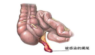 惡性闌尾炎手術后注意事項